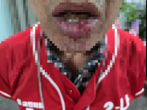 대구에서 국민의힘 소속 기초의원 후보의 선거운동원이 한 60대 남성에게 무차별 폭행을 당해 하관이 찢어진 모습. [독자]