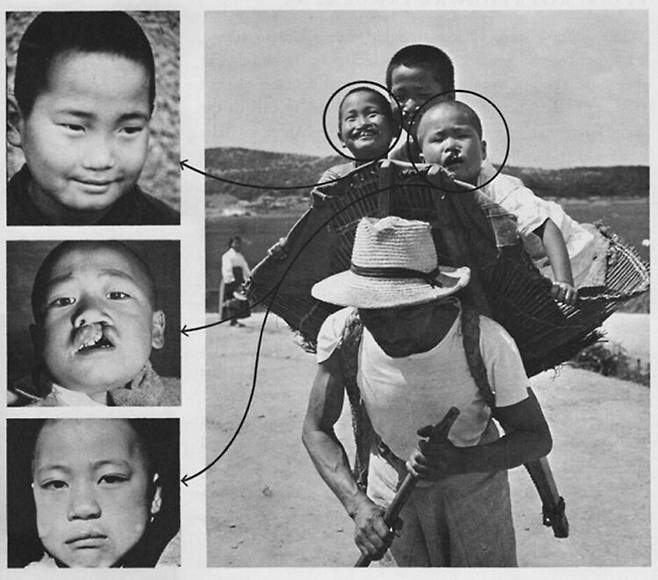 지게를 타고 수술을 받으러 온 형제들. 이 중 두 명이 일측성, 한명은 양측성 구순열로 보입니다. 사진=Cleft Craft