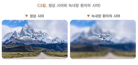 녹내장 환자의 시야 비교 [국가건강정보포털]