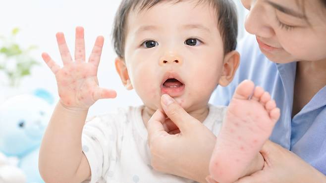수족구병은 손과 발, 입안에 뚜렷한 병변이 나타나는 것을 특징으로 하는 질환이다