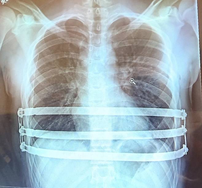 자로주스키 박사가 팩투스(Pectus) 수술을 집도 한 후 촬영한 흉부 X-ray 영상 이미지.&nbsp;/엘앤케이바이오메드 제공