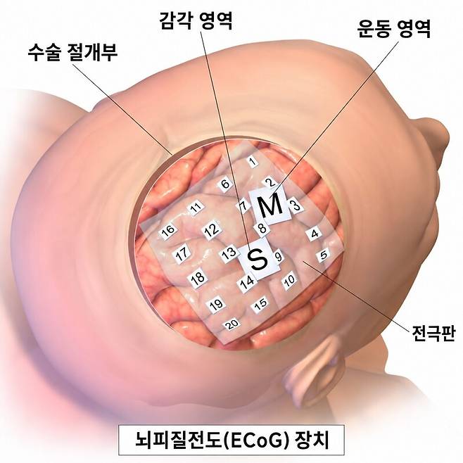 두피에 전극을 붙여 간접적으로 뇌 신호를 측정하는 뇌파검사(EEG)와 달리, 뇌피질전도는 두피 아래 대뇌 피질 표면에 직접 전극을 붙여 뇌의 전기 신호를 기록한다. 위키미디어 코먼스