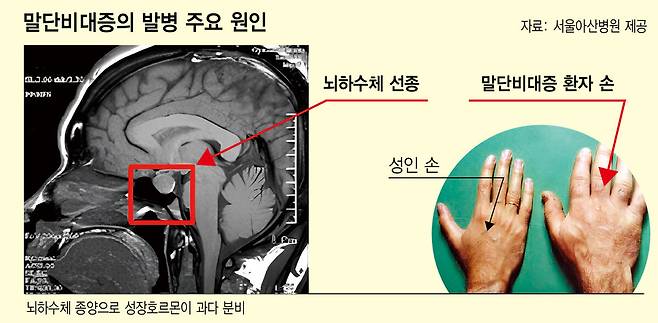 말단비대증의 발병 주요 원인. 서울아산병원 제공