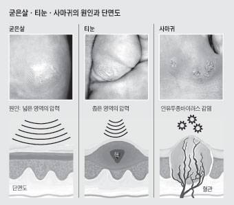 티눈은 각질 윗부분에 핵이 있는 반면 굳은살은 핵이 없다. 사마귀는 티눈과 달리 검붉은 핏자국이 보인다. 사진-조선일보DB