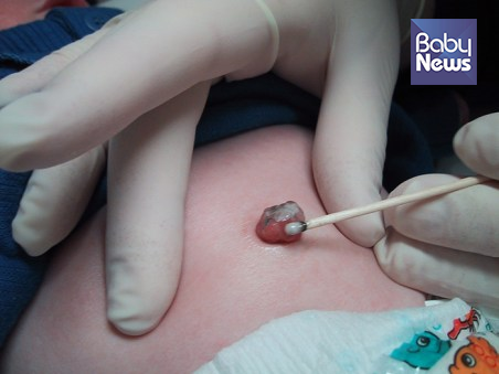 신생아 배꼽은 염증이 생길 수 있으므로 소독을 열심히 해야 합니다. ⓒ신정욱