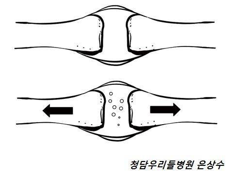 손가락에서 뚝 소리가 나는 이유 /사진-은상수 전문의 제공