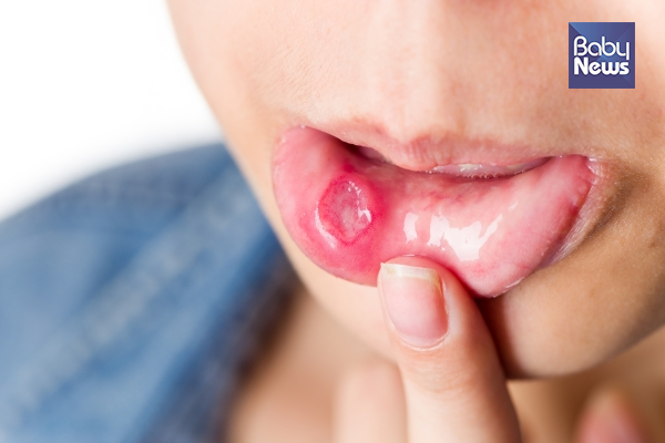 영유아에게서 입병이 나는 경우에는 보호자들이 당황하는 경우가 많습니다 ⓒ베이비뉴스