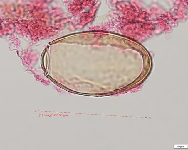 미라 폐에서 발견된 폐흡충알 사진(길이 0.08mm)