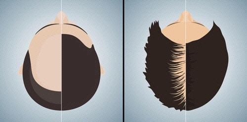 대머리로 불리는 남성형 탈모증(왼쪽)과 중심부 머리숱이 적어지는 여성형 탈모증(오른쪽)의 전형적인 모습. /사진제공=서울대병원