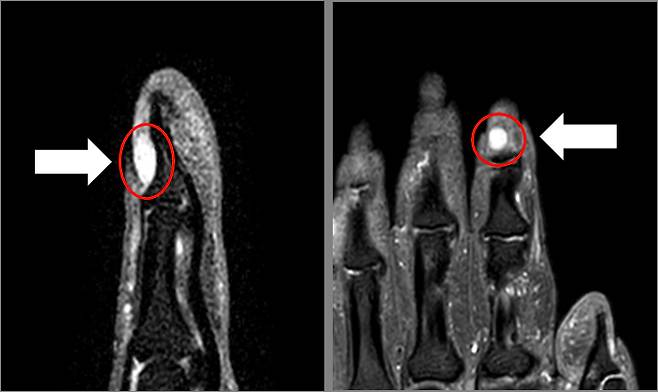 손가락 끝의 사구체 종양. MRI 상 진단이 가능하다. 강동성심병원 제공.