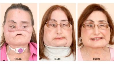 안면이식수술을 받기 전과 후의 달라진 모습