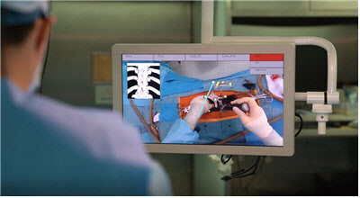 척추 고정에 사용할 나사못이 들어갈 위치를 오버레이 그래픽으로 환자 수술 부위에 투영시켜 보여주는 모습