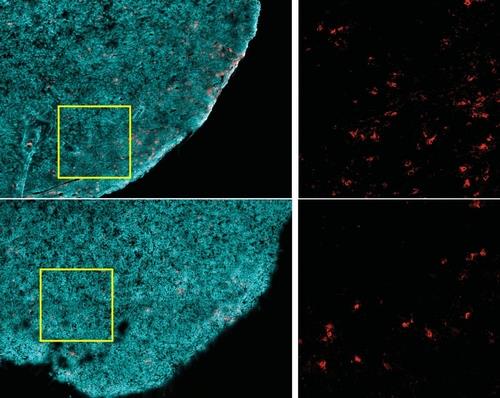 T세포 감소 암세포만 골라 죽이는 CD8+ T세포(적색)는, 비만한 생쥐(하단)보다 비만하지 않은 생쥐(상단)의 종양에 더 많다.   [하버드의대 Ringel 등 제공 / 재판매 및 DB 금지]