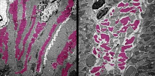 미토콘드리아 손상 신종 코로나 감염 생쥐의 심근 세포(우)에서 미토콘드리아(분홍색)가 파괴된 모습.  심근 세포의 이런 변화는 불규칙한 심장 박동과 심장 돌연사로 이어질 수 있다.   [UCLA 브로드 줄기세포 연구 센터 제공 / 재판매 및 DB 금지]