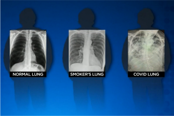 [사진=(왼쪽부터) 엑스레이로 촬영한 건강한 사람의 폐, 흡연자의 폐, 코로나19 환자의 폐. Unbiased Science Podcast, Brittany Bankhead-Kendall twitter]