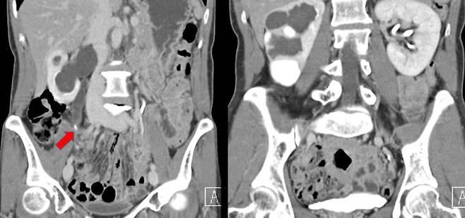 우측 신장에 있는 결석(빨강색 화살표·왼쪽 사진), 요관결석으로 인해 확장된 우측 요관이 보인다(신장에서 시작된 검은 관). 이로 인해 수신증을 보이는 우측 신장(오른쪽 사진, 우측 신장), 이와 대조적인 정상 신장(오른쪽 사진, 좌측 신장)