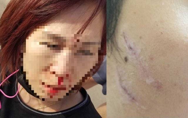 코뼈가 부러지고 타박상을 입은 김 씨. 트위터 갈무리