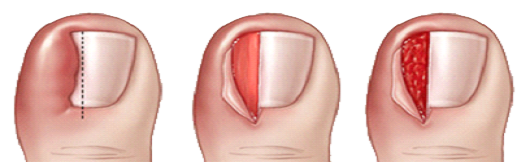 내성 발톱 부분 절제술 / 선상규 원장 제공
