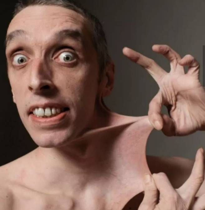 ‘엘러스 단로스 증후군’ 영국 남성. 세계 기네스 협회 공식 인스타그램 캡처