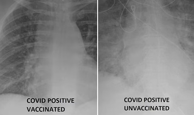 사진 왼쪽은 백신 접종 후 코로나19에 감염된 환자의 폐 X레이 사진, 오른쪽은 백신을 맞지 않은 상태에서 코로나19에 감염된 환자의 폐 X레이 사진