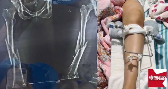 중국에서 요가수업 중 강사의 무리한 자세교정으로 골절상을 입는 사고가 발생했다. ['성시빈' 캡처]