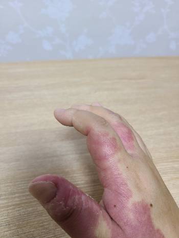 시선이 느껴져 불안하거나 혼자 있게 됐을 때, 엄지 손가락을 이렇게 뜯는 게 버릇이 됐다. 그를 바라보는 시선에 "왜 그렇게 보느냐"고 당당히 따지지 못하고, 대신 그의 손을 뜯는 걸로 안정을 얻는단다. 심리 지원이 필요한 이유라고 했다./사진=김민혜님