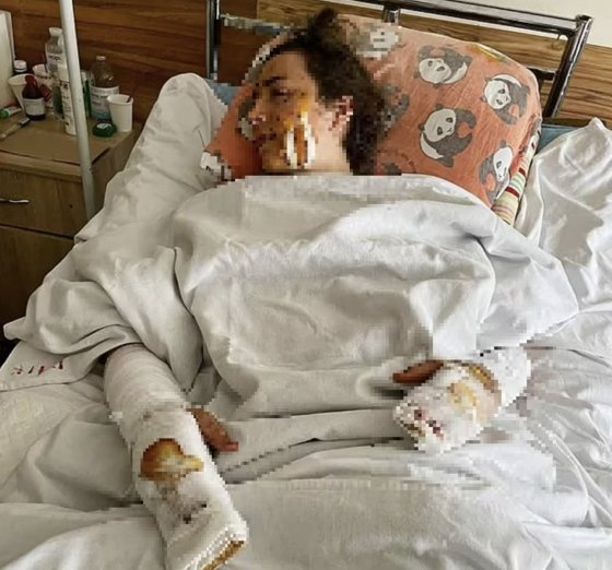 우크라이나로 신혼여행을 떠났다가 100년 전 묻힌 폭탄이 터지면서 큰 부상을 입은 리디아 마카추크가 병원에 입원해 있는 모습 [데일리메일 캡처]