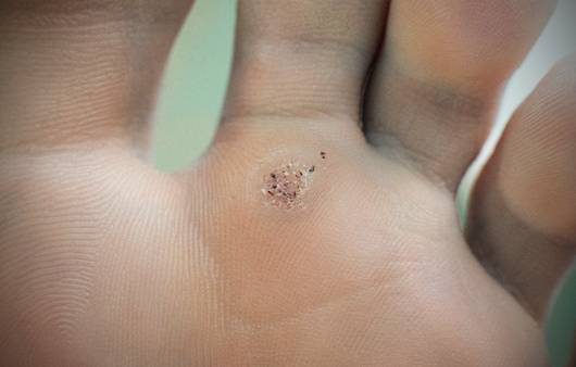 사마귀는 '점상 출혈'을 보인다