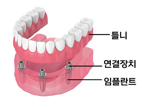 임플란트 틀니