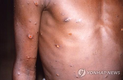 1996~1997년 콩고민주공화국의 원숭이 두창 유행 당시 조사 과정에서 촬영한 환자의 상반신과 팔의 피부 병변 [로이터 연합뉴스 자료사진.질병통제예방센터(CDC) 제공. 재판매 및 DB 금지]