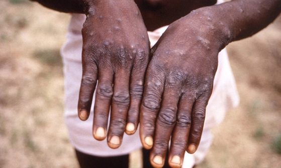 지난 1997년 원숭이두창에 걸린 콩고민주공화국 환자가 미국 질병통제예방센터(CDC) 관계자에게 손등에 생긴 수포를 보이고 있다. 〈사진=CDC 제공〉