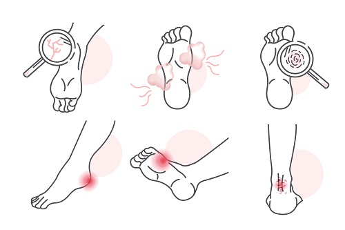 당뇨환자는 발에 상처가 생기면 잘 낫지 않고 상태가 급격히 진행돼 다양한 증상이 발생할 수 있다. 발을 매일 세심하게 관찰하고 외출 시 맨발은 피해야 한다(사진=클립아트코리아).