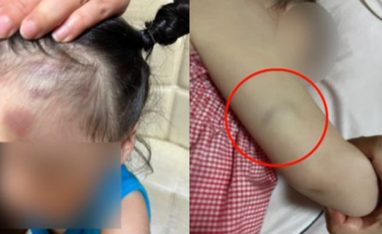 전남 여수의 한 어린이집에서 보육 교사가 생후 20개월 된 여아를 학대했다는 신고가 접수돼 경찰이 수사에 나섰다. 사진=SBS 보도 화면 캡처