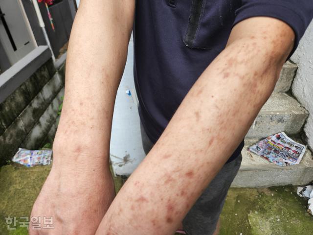 10일 경기 시흥시 대야동 반지하 집에 살고 있는 정모씨가 벌레에 물려 상처투성이가 된 두 팔을 내보이고 있다. 나주예 기자