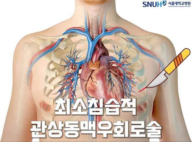 최소침습적 관상동맥우회로술.   서울대병원  