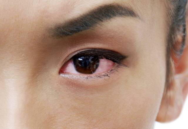 한쪽 눈만 유독 충혈이 심하다면 '눈 대상포진'일 수도 있다./사진=클립아트코리아