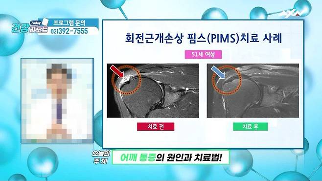 ▲방송통신심의위원회 안건으로 올라온AXN 투데이건강리포트 방송 화면 갈무리.