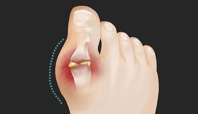 통풍이 생긴 발. 이미지투데이