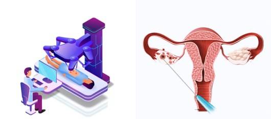로봇수술ㅣ출처: 게티 이미지뱅크, 경화술 치료ㅣ출처: 최상산부인과의원