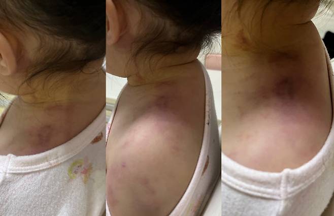 경기 안산시의 한 어린이집에서 아동학대 의심 신고가 접수돼 경찰이 수사에 나섰다. 사진은 피해 아동의 모습 (사진=SNS)