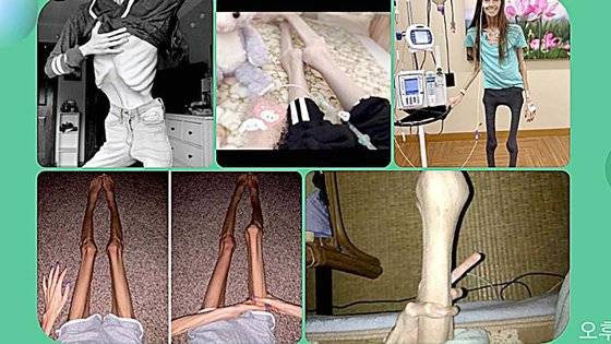 프로 아나 관련 10대 카카오톡 오픈 채팅방에서 '자극짤'(자극을 주는 사진)로 공유되는 사진들.