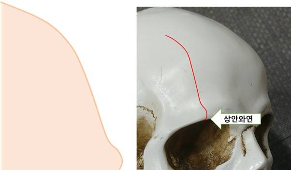 이마 부위 옆라인은 이런 느낌입니다.
