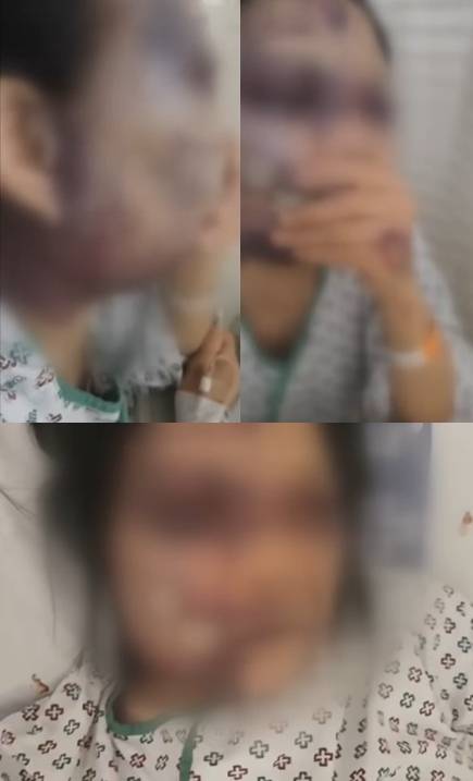 새까만 멍 자국으로 뒤덮인 B씨의 얼굴과 목. (KBS)