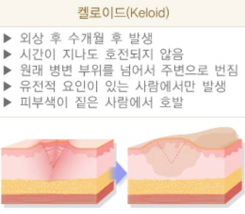 켈로이드(Keloid) 흉터의 특징. 사진제공=질병관리청