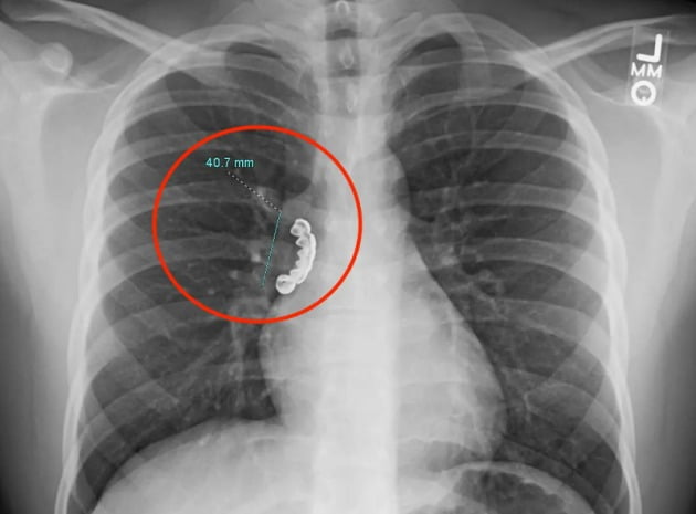 환자의 흉부 엑스레이에 찍힌 사진 '그릴즈'의 모습. /사진 출처= 국제 학술지 큐레우스