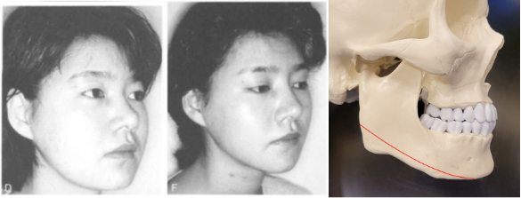 아래턱 전체를 줄여야 합니다. 현재는 대부분 이렇게 수술하고 있습니다. Aesthetic Plastic Surgery volume 19,93(1995)