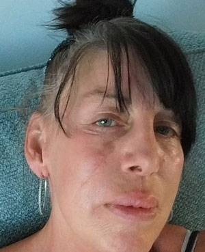 왼쪽 뺨에 생긴 검은색 점과 주근깨를 ‘흑색종 4기’로 진단 받은 케이 우튼./사진=영국 데일리메일