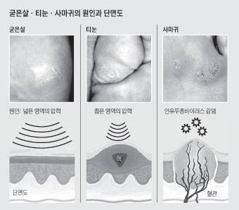굳은살, 티눈, 사마귀의 원인과 단면도./사진=헬스조선DB