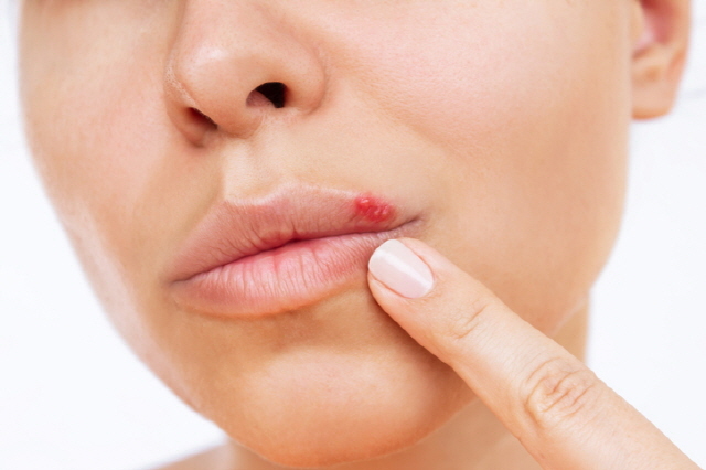 면역력이 떨어지면 입안에 혓바늘이 잘 돋고, 입술 주위에 작은 수포가 여러 개 나타나는 헤르페스성구내염이 흔히 나타날 수 있다./사진=게티이미지뱅크
