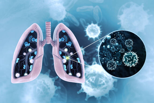 인공지능으로 인공호흡기가 필요한 중증 코로나19 환자 585명의 건강 상태를 분석한 새로운 연구결과 분석 대상이 된 환자의 절반이 2차 감염으로 세균성 폐렴에 걸린 것을 발견했다. [사진=게티이미지뱅크]